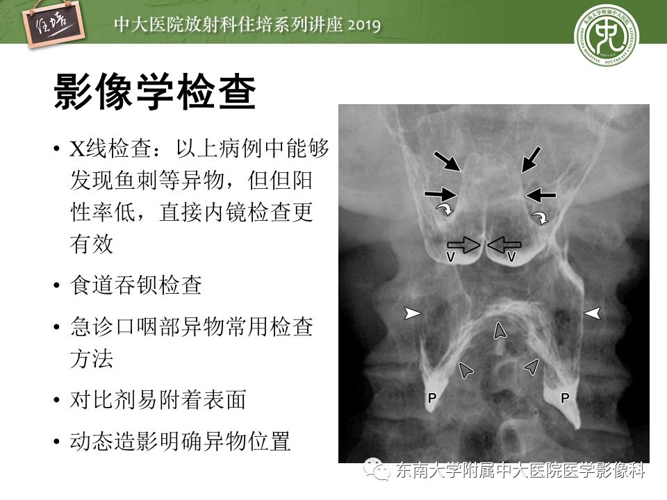 【PPT】口咽部异物及感染性病变的影像诊断