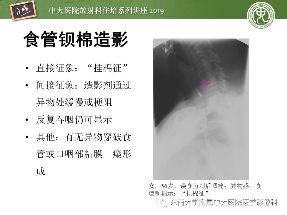 【PPT】口咽部异物及感染性病变的影像诊断