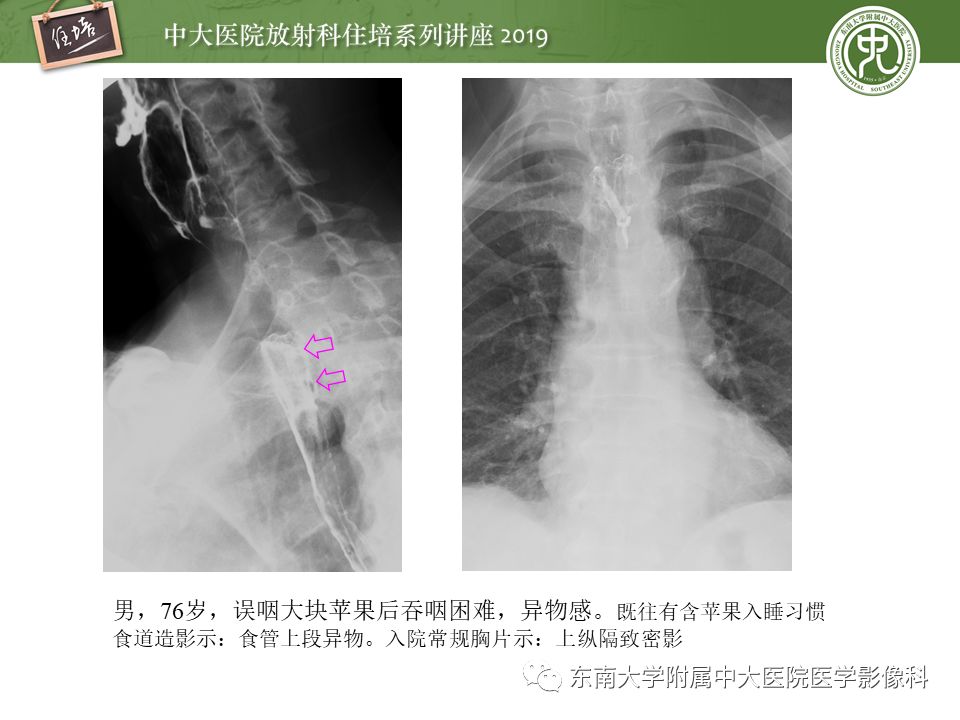 【PPT】口咽部异物及感染性病变的影像诊断