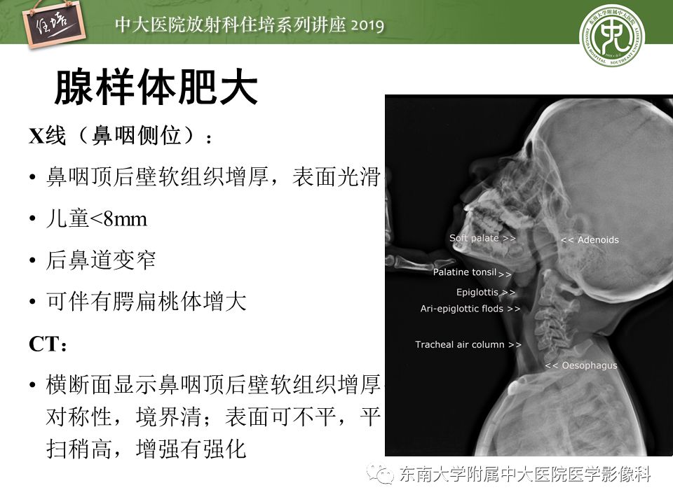 【PPT】口咽部异物及感染性病变的影像诊断
