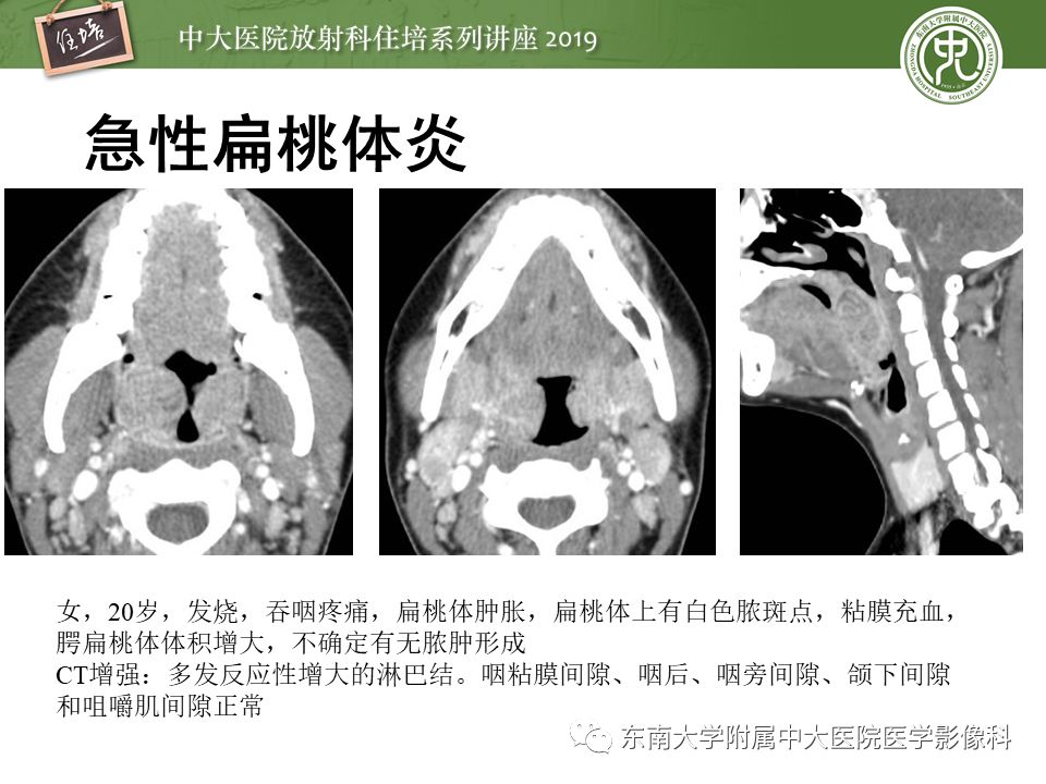 【PPT】口咽部异物及感染性病变的影像诊断