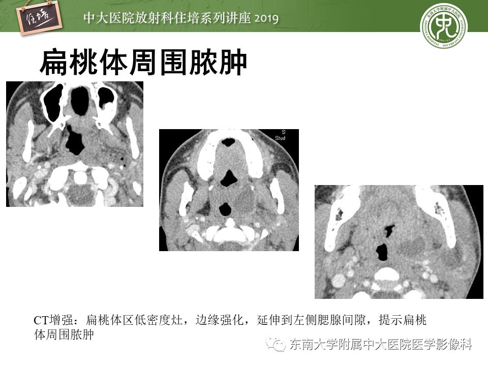 【PPT】口咽部异物及感染性病变的影像诊断