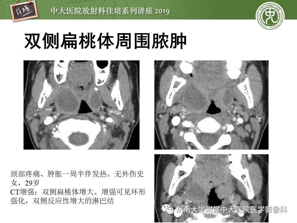 【PPT】口咽部异物及感染性病变的影像诊断