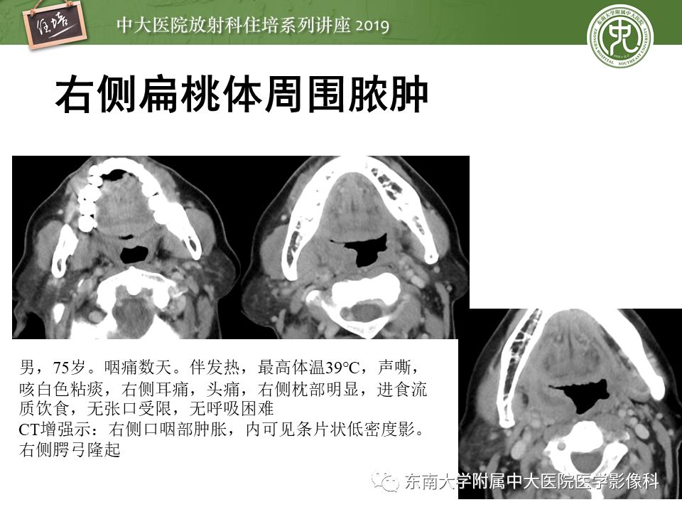 【PPT】口咽部异物及感染性病变的影像诊断