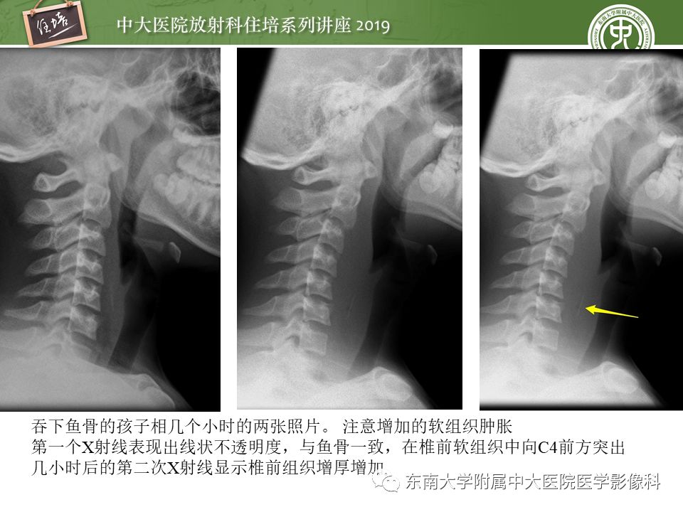 【PPT】口咽部异物及感染性病变的影像诊断