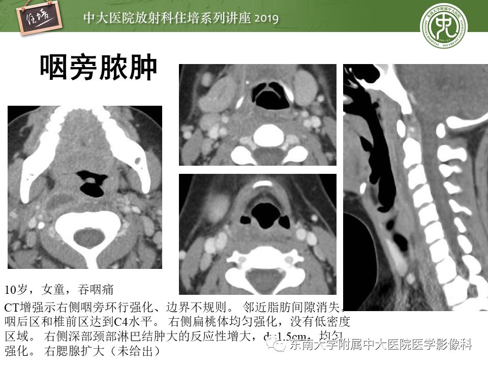 【PPT】口咽部异物及感染性病变的影像诊断