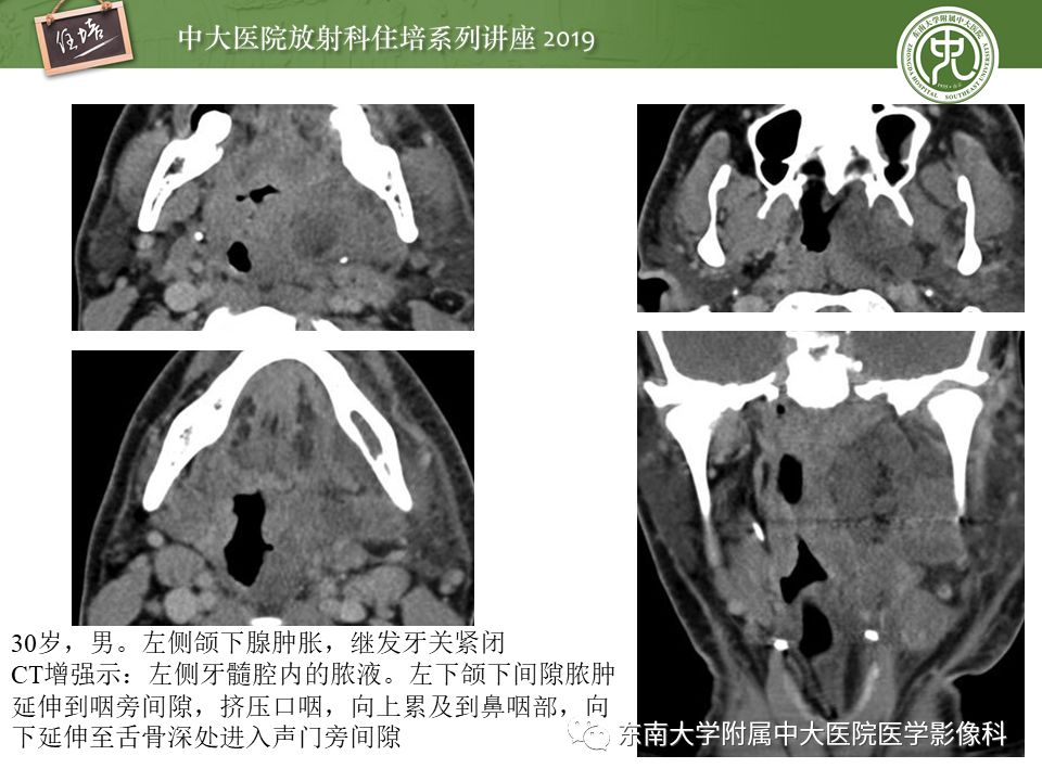 【PPT】口咽部异物及感染性病变的影像诊断