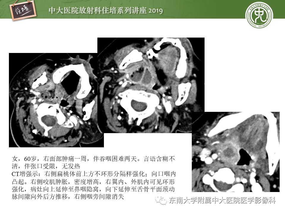 【PPT】口咽部异物及感染性病变的影像诊断