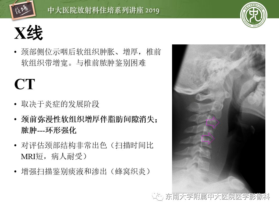 【PPT】口咽部异物及感染性病变的影像诊断