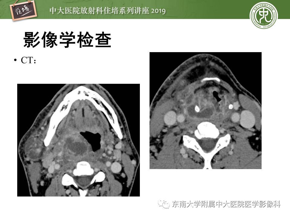 【PPT】口咽部异物及感染性病变的影像诊断