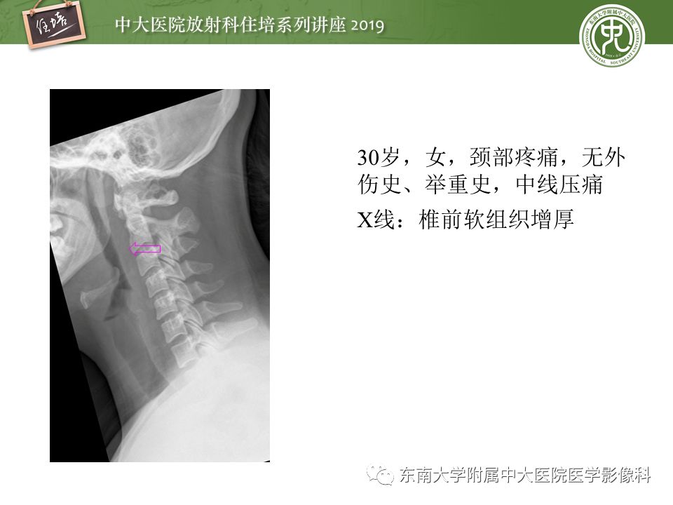 【PPT】口咽部异物及感染性病变的影像诊断