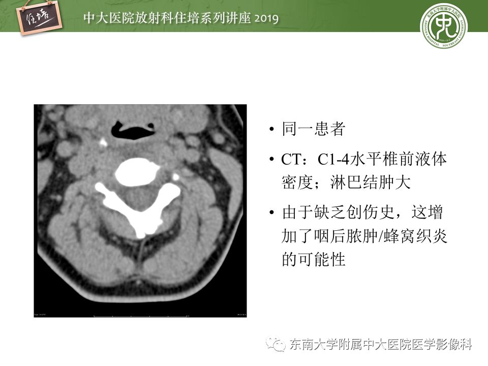 【PPT】口咽部异物及感染性病变的影像诊断