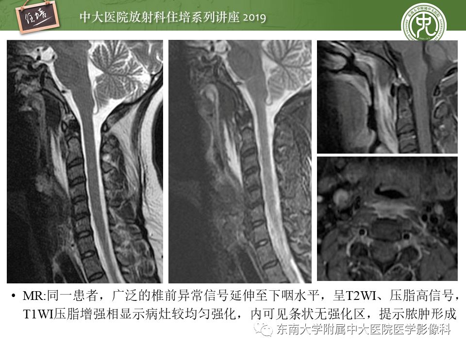 【PPT】口咽部异物及感染性病变的影像诊断