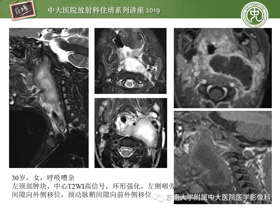【PPT】口咽部异物及感染性病变的影像诊断