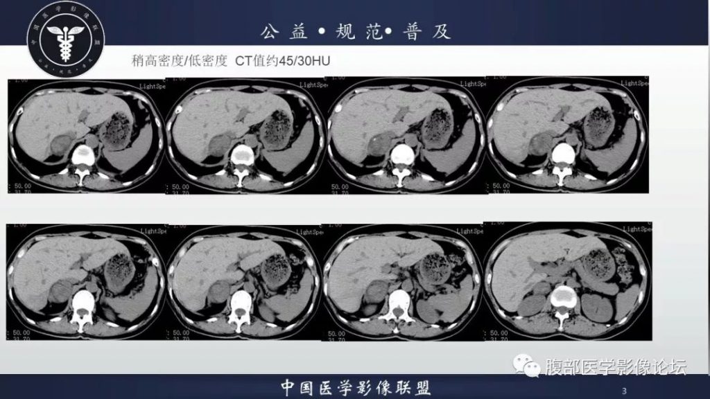 【病例】肾上腺皮质腺瘤伴出血1例CT影像