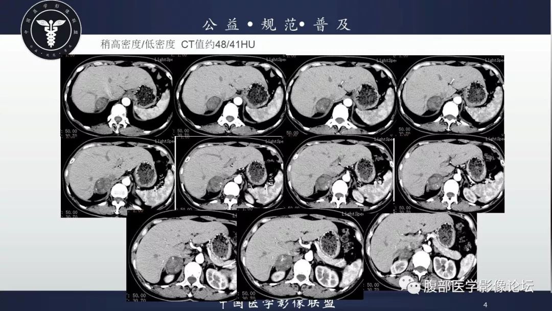 【病例】肾上腺皮质腺瘤伴出血1例CT影像