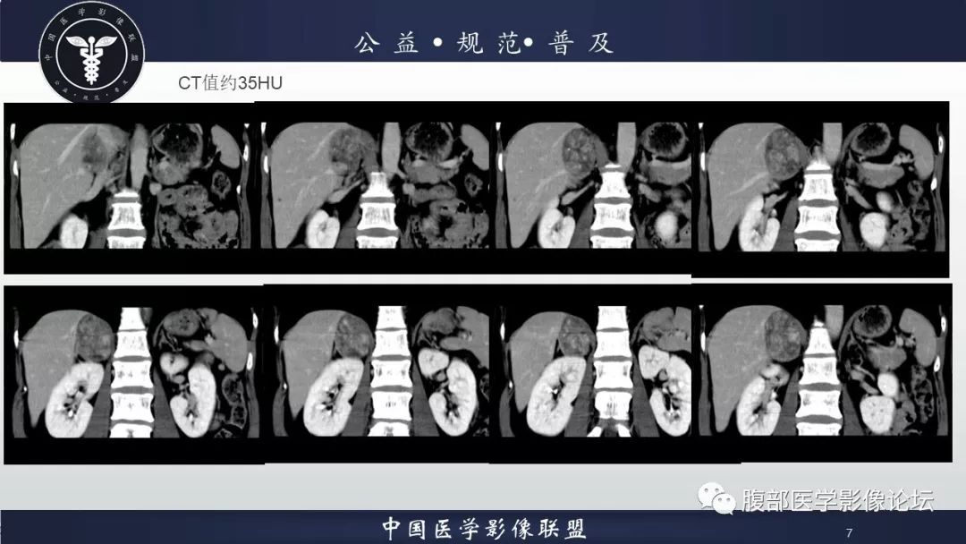 【病例】肾上腺皮质腺瘤伴出血1例CT影像