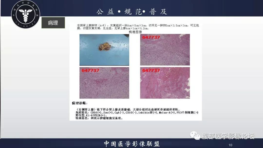 【病例】肾上腺皮质腺瘤伴出血1例CT影像