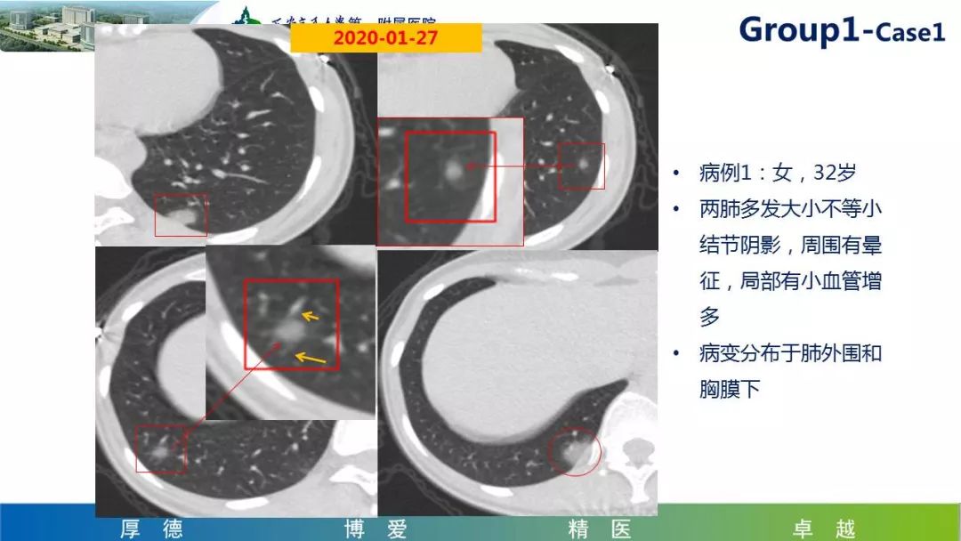 【PPT】19-nCoV新型冠状病毒肺炎患者影像学病例分享第二期