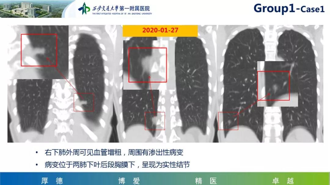 【PPT】19-nCoV新型冠状病毒肺炎患者影像学病例分享第二期