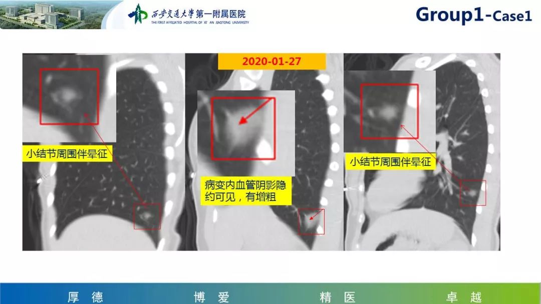 【PPT】19-nCoV新型冠状病毒肺炎患者影像学病例分享第二期