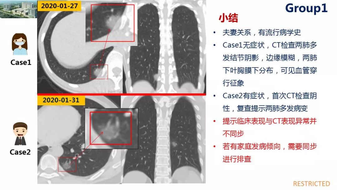 【PPT】19-nCoV新型冠状病毒肺炎患者影像学病例分享第二期