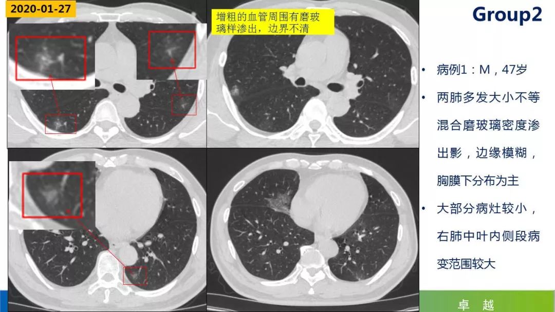 【PPT】19-nCoV新型冠状病毒肺炎患者影像学病例分享第二期