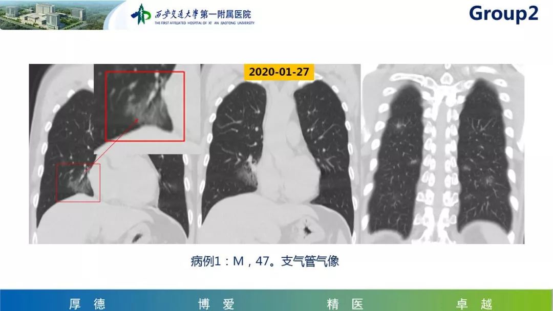 【PPT】19-nCoV新型冠状病毒肺炎患者影像学病例分享第二期