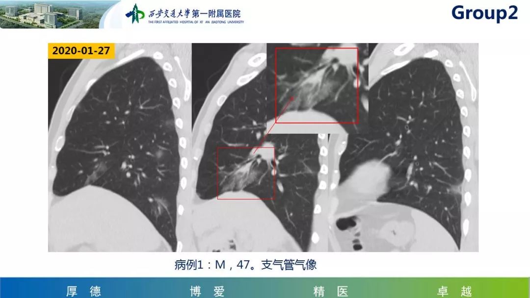 【PPT】19-nCoV新型冠状病毒肺炎患者影像学病例分享第二期