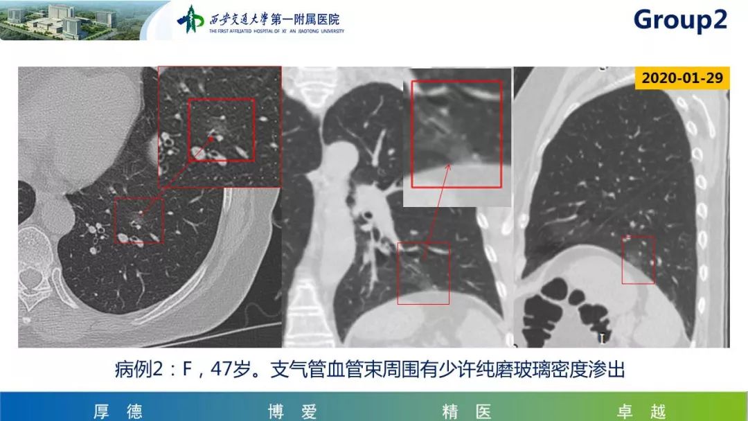 【PPT】19-nCoV新型冠状病毒肺炎患者影像学病例分享第二期