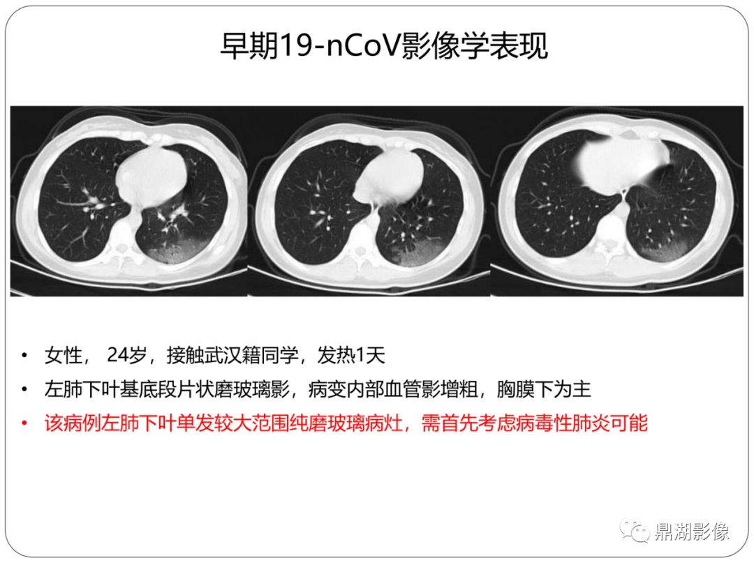 【PPT】新冠状病毒肺炎影像学诊断