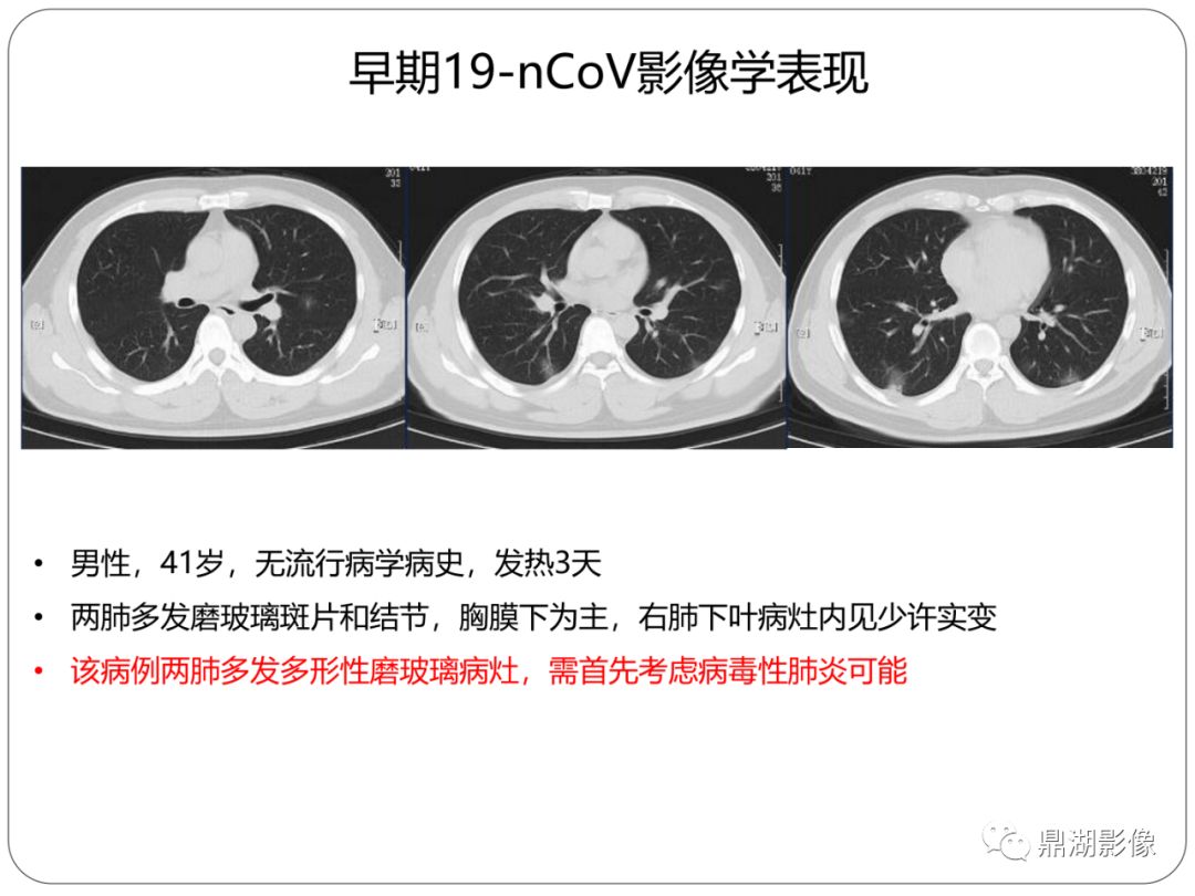 【PPT】新冠状病毒肺炎影像学诊断