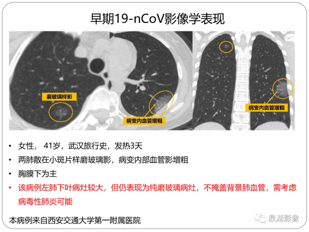 【PPT】新冠状病毒肺炎影像学诊断