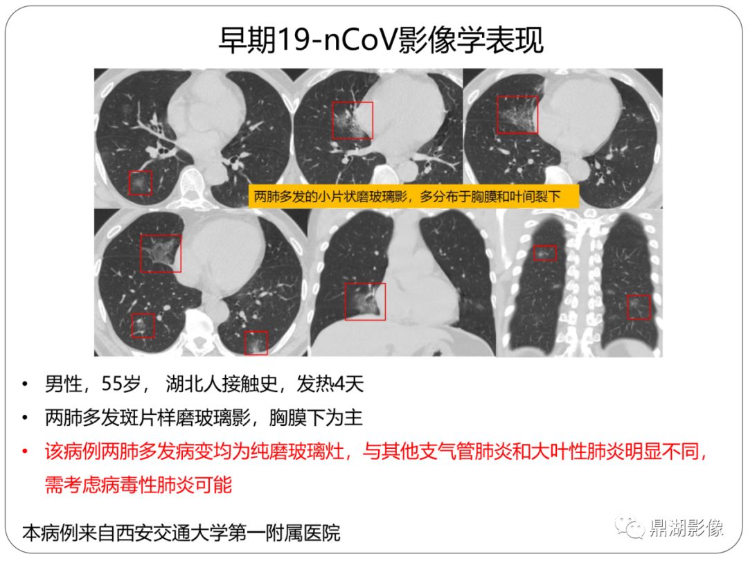 【PPT】新冠状病毒肺炎影像学诊断