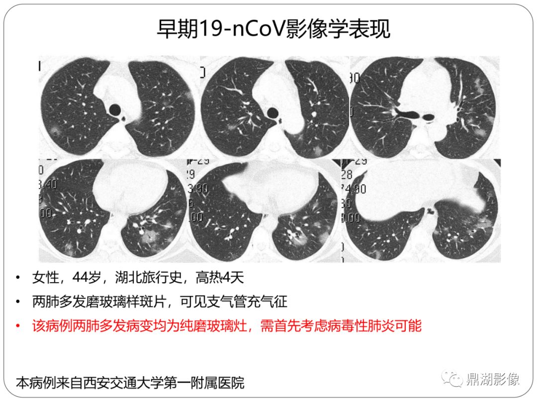 【PPT】新冠状病毒肺炎影像学诊断