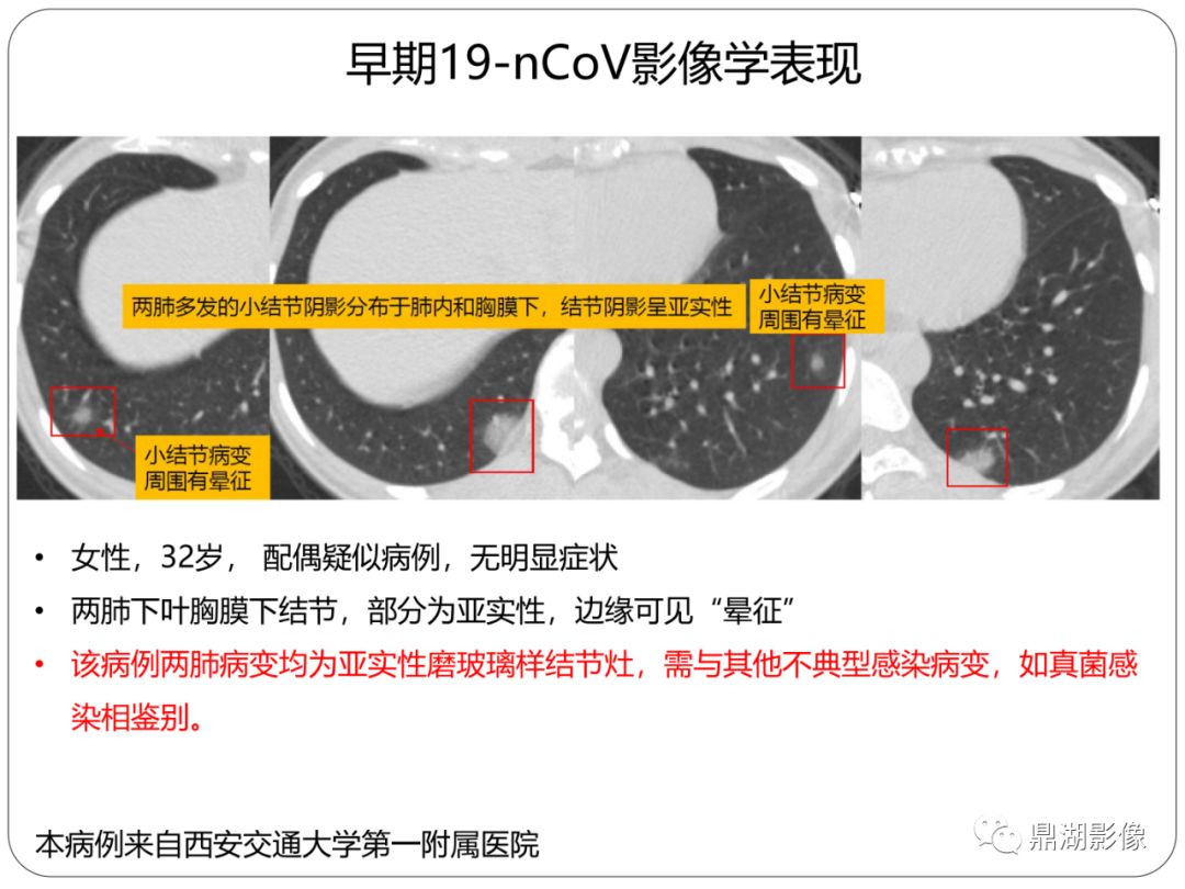 【PPT】新冠状病毒肺炎影像学诊断