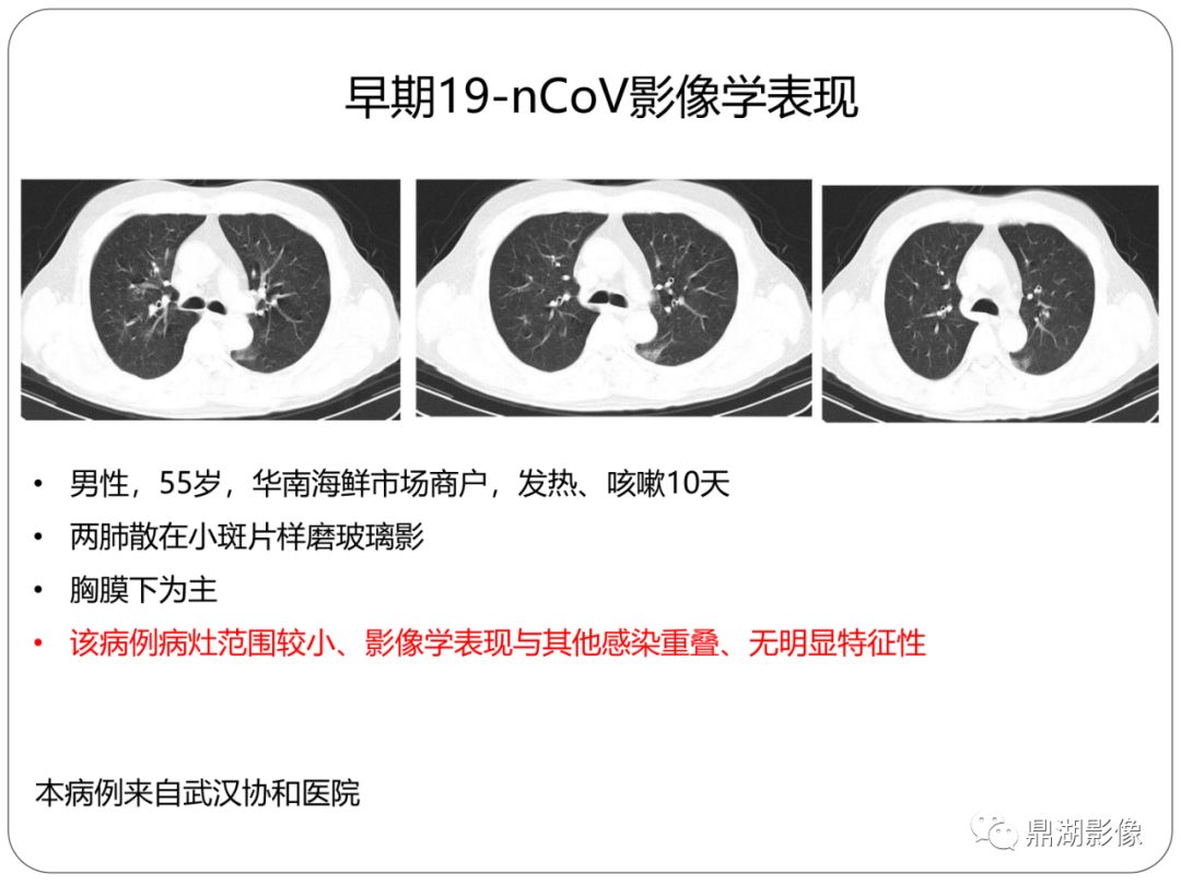 【PPT】新冠状病毒肺炎影像学诊断