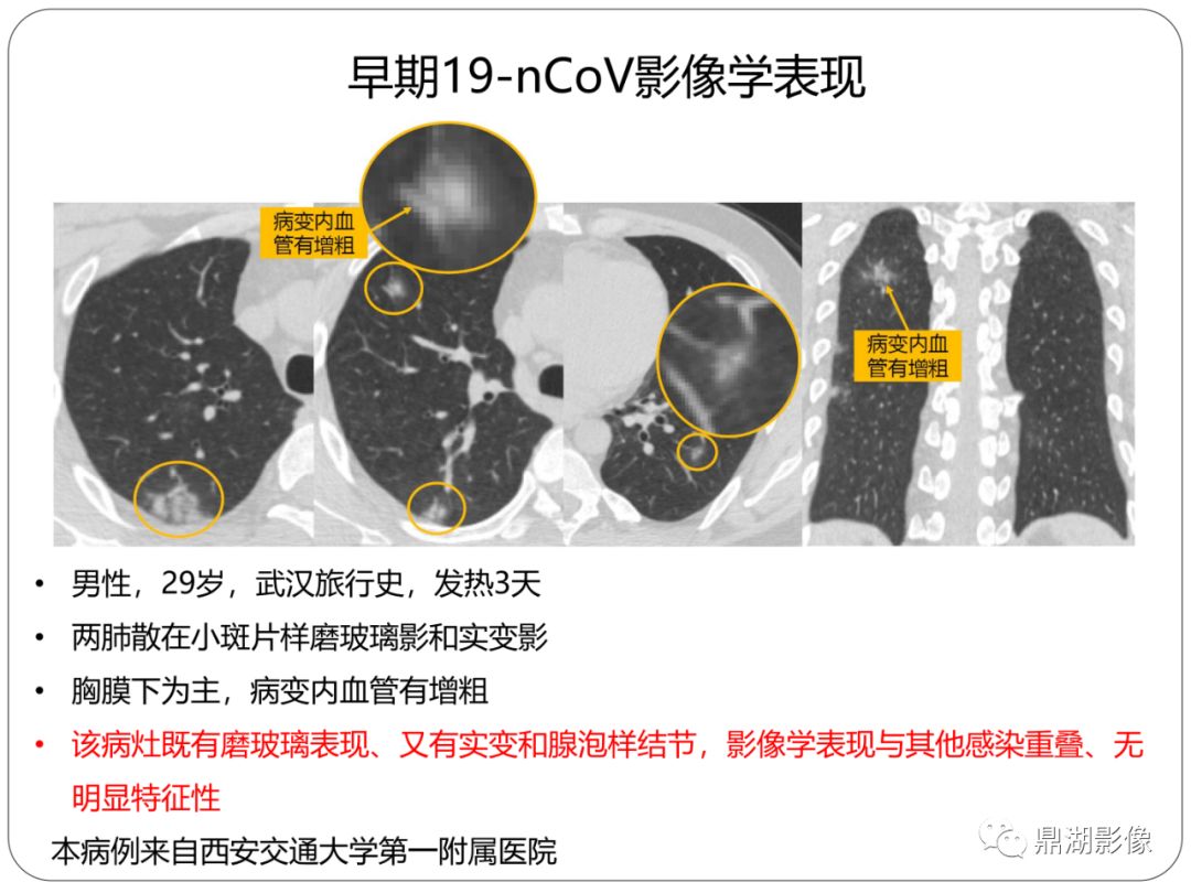【PPT】新冠状病毒肺炎影像学诊断