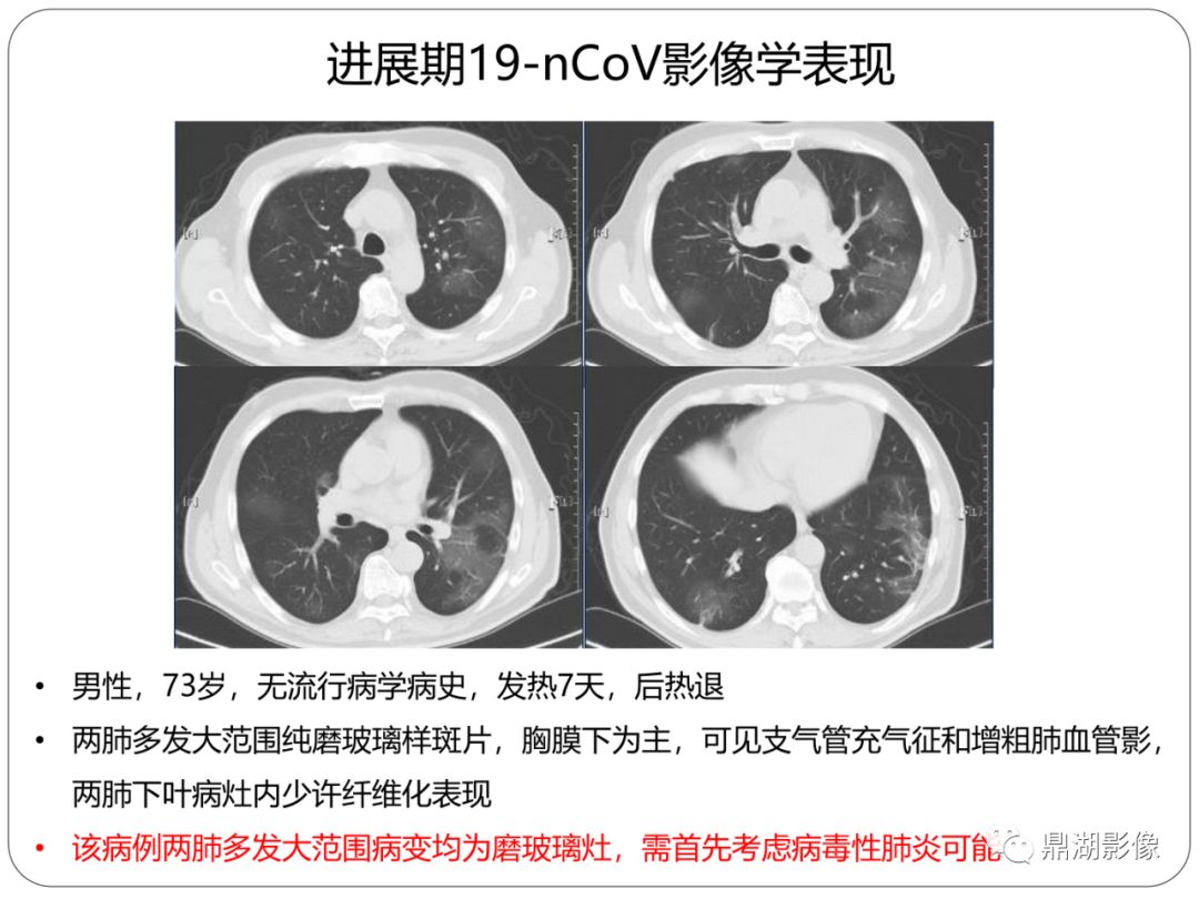 【PPT】新冠状病毒肺炎影像学诊断