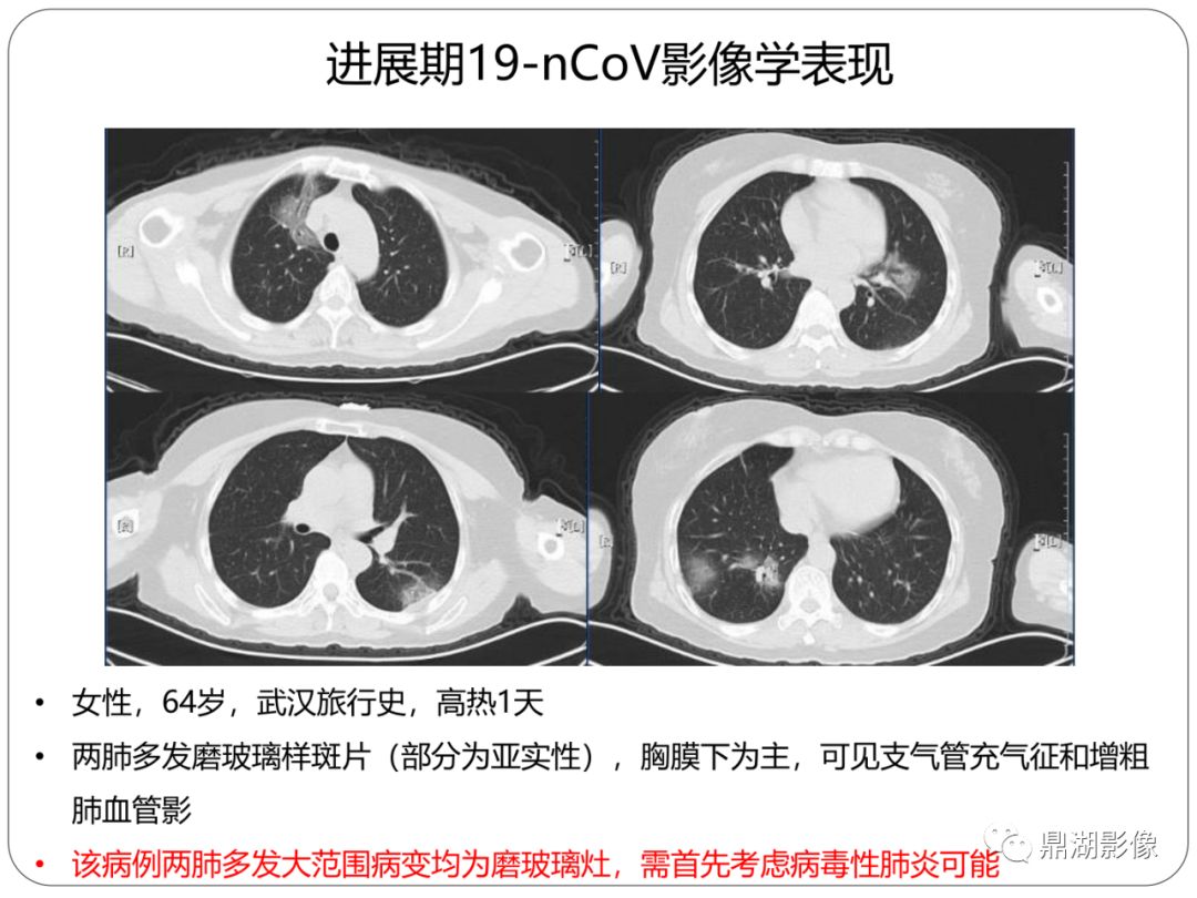 【PPT】新冠状病毒肺炎影像学诊断