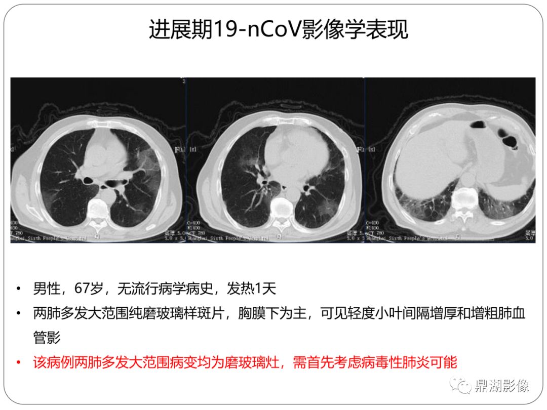 【PPT】新冠状病毒肺炎影像学诊断