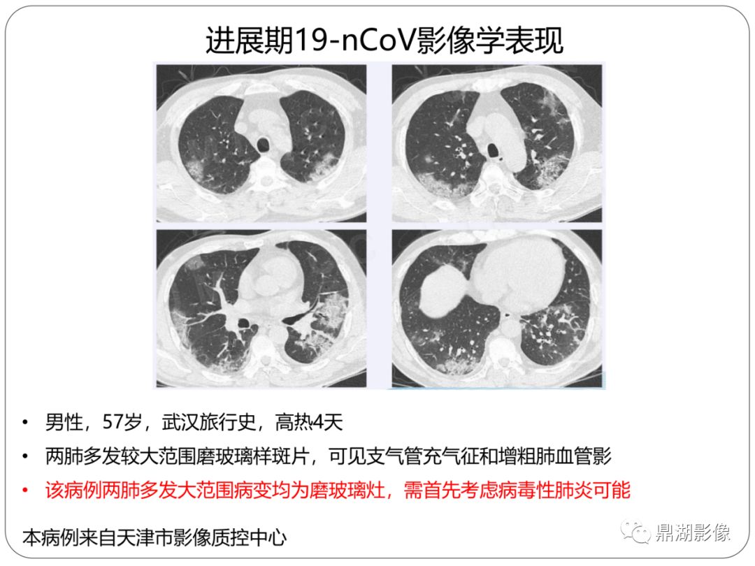 【PPT】新冠状病毒肺炎影像学诊断
