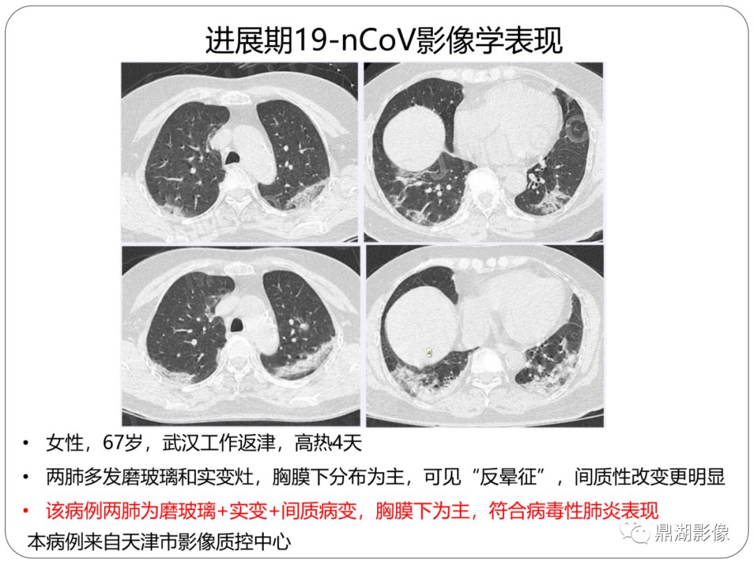 【PPT】新冠状病毒肺炎影像学诊断
