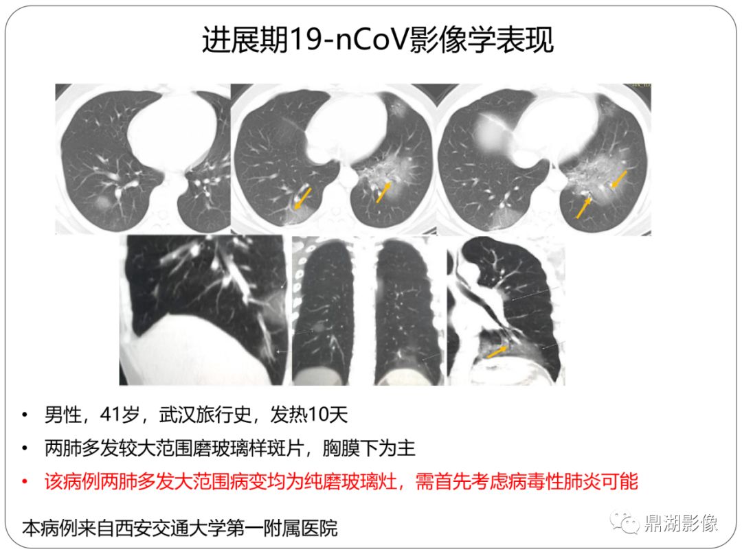 【PPT】新冠状病毒肺炎影像学诊断