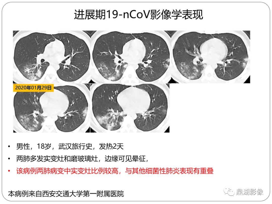 【PPT】新冠状病毒肺炎影像学诊断