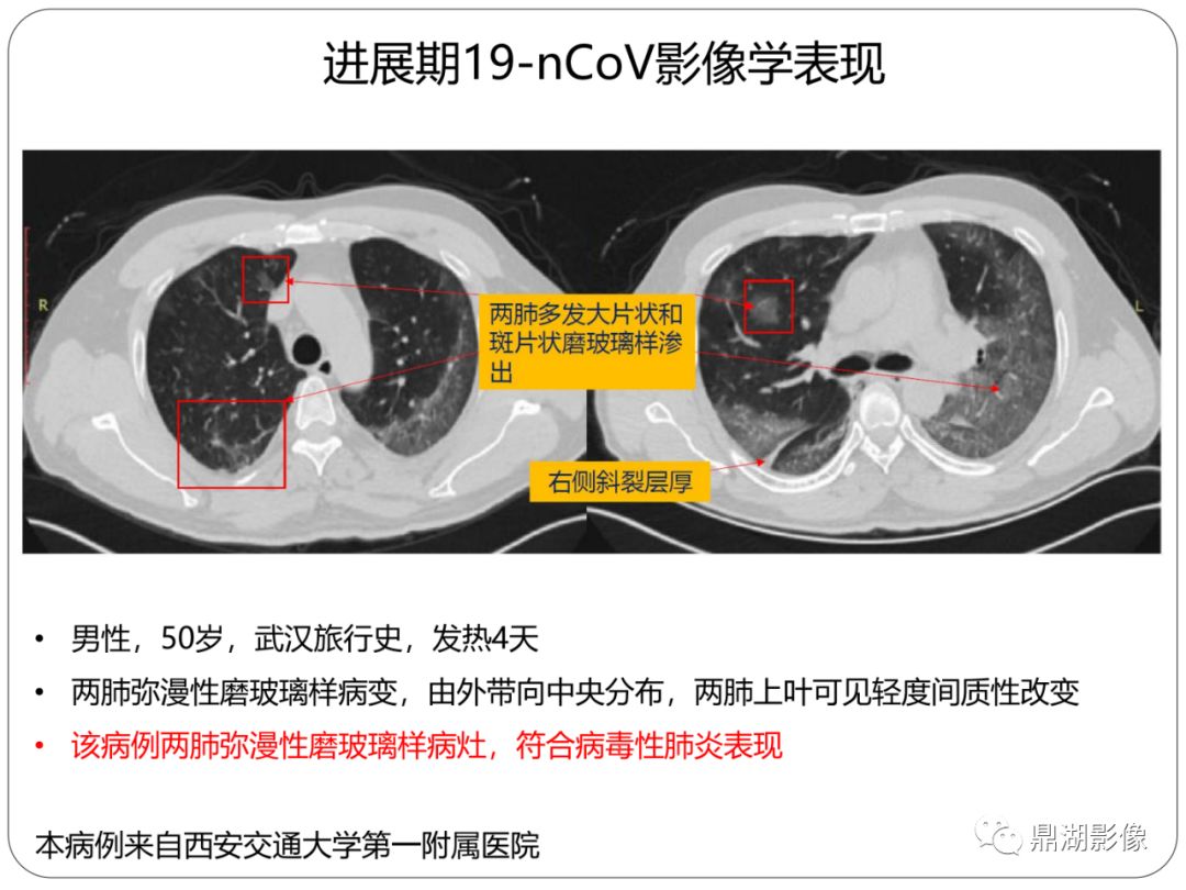 【PPT】新冠状病毒肺炎影像学诊断