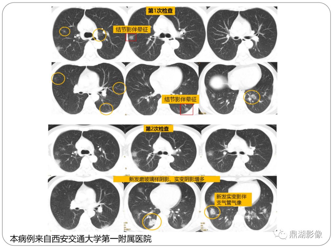【PPT】新冠状病毒肺炎影像学诊断