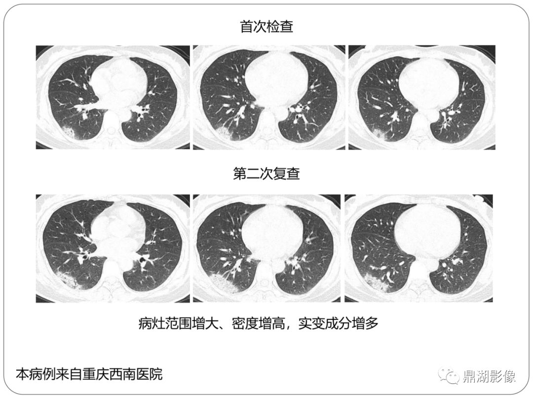 【PPT】新冠状病毒肺炎影像学诊断