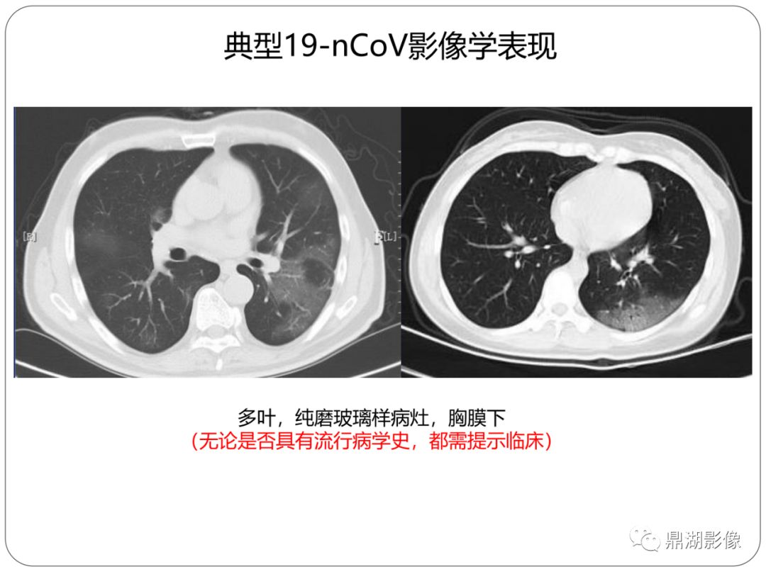 【PPT】新冠状病毒肺炎影像学诊断