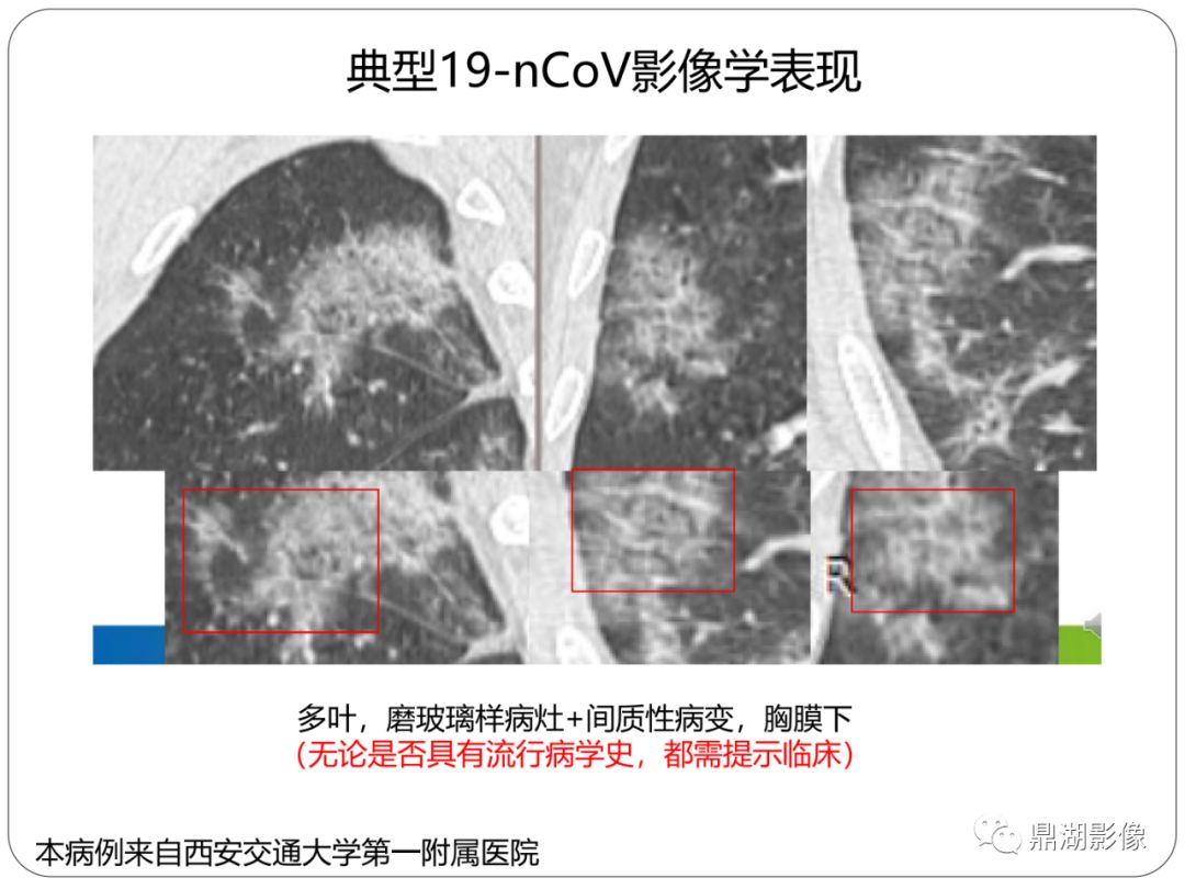 【PPT】新冠状病毒肺炎影像学诊断